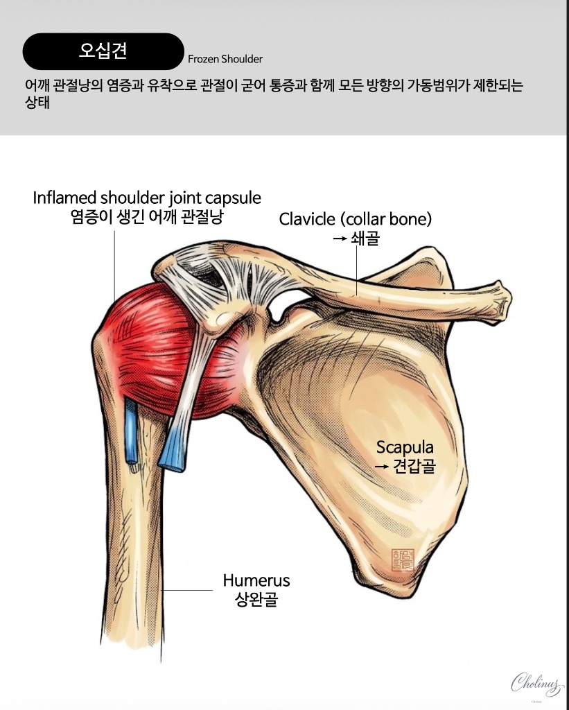 유착성 관절낭염 해부도