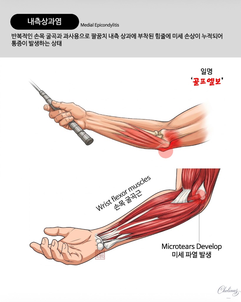 내측 상과염 (골프 엘보) 해부도