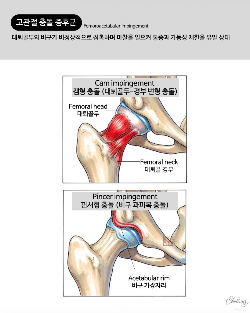 고관절 충돌 증후군 해부도