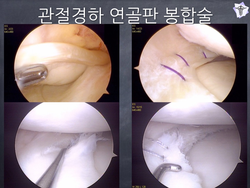 관절경하 연골판 봉합술