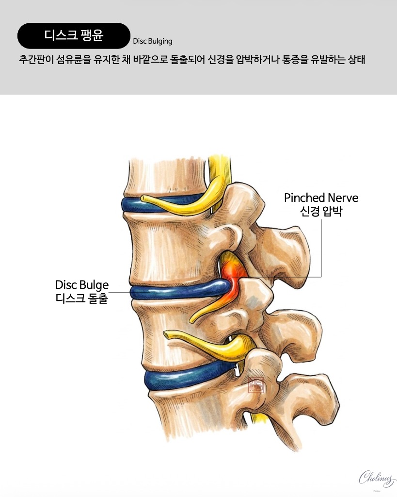 디스크 팽윤 해부도