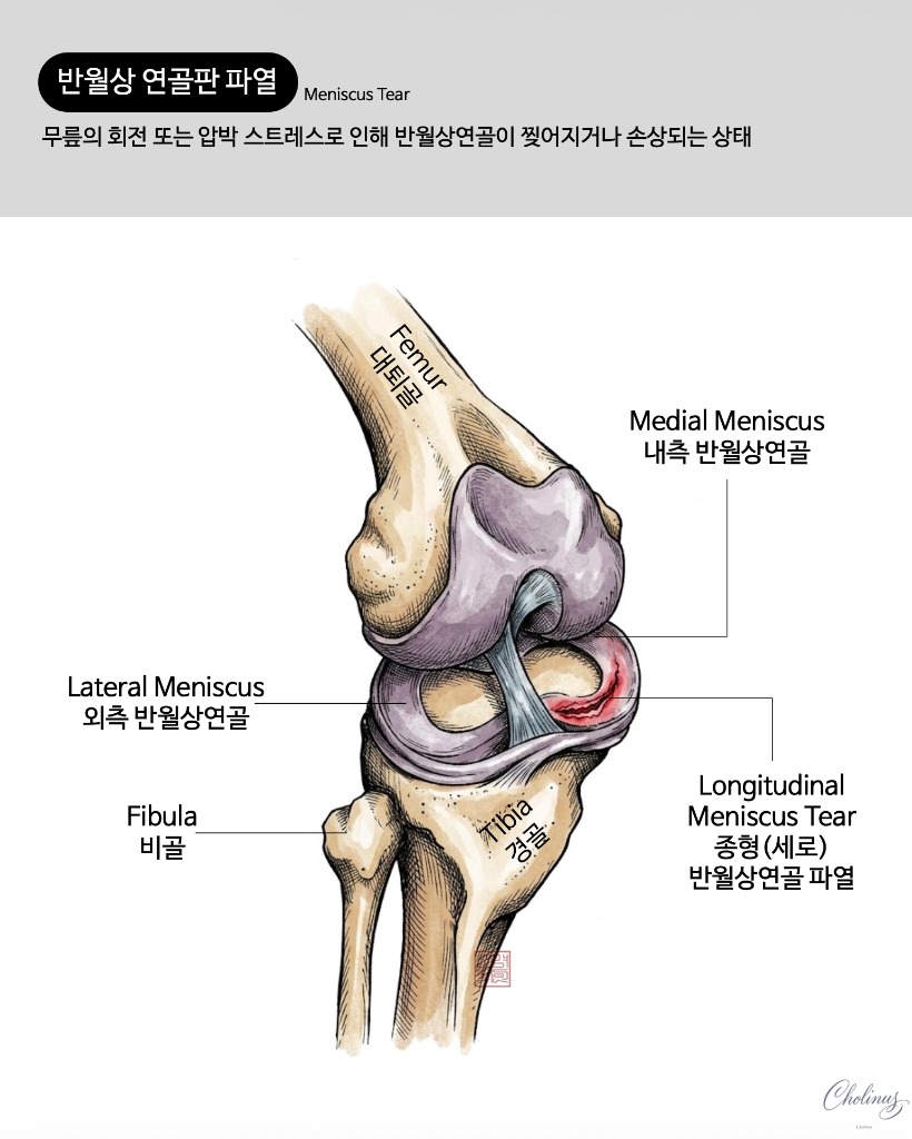 반월상 연골판 파열 해부도