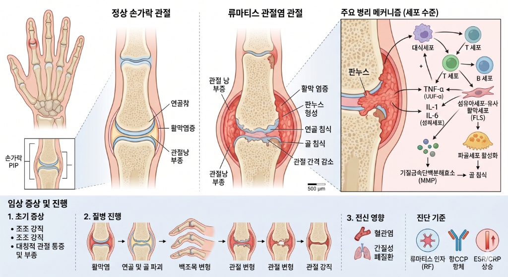 류마티스 관절염 주요 병리 메커니즘 및 진행 단계 해부도