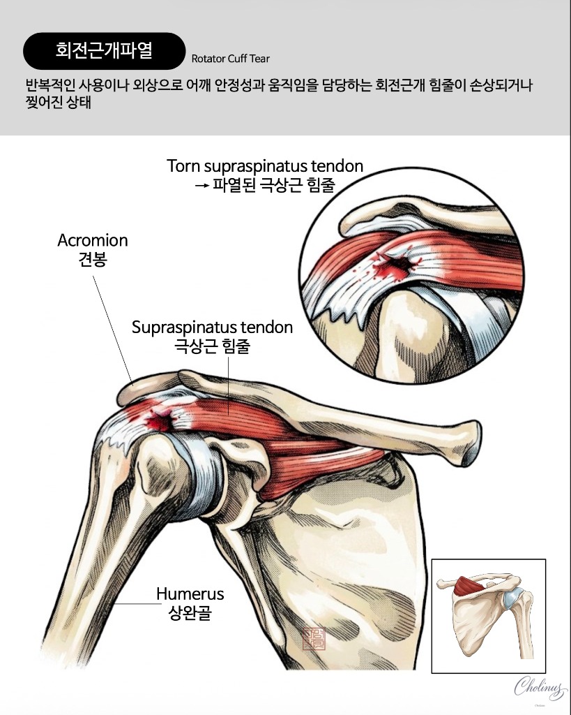 회전근개 파열 해부도