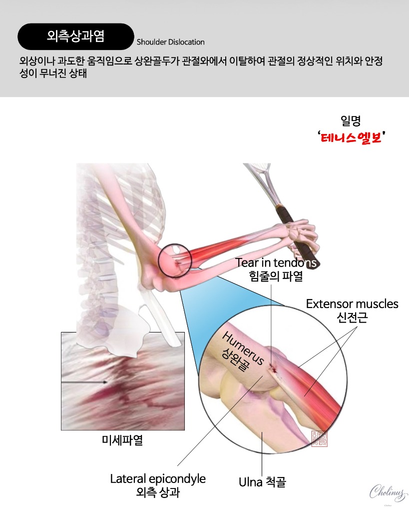 외측 상과염 (테니스 엘보) 해부도